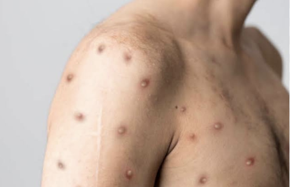 Mpox Declared Public Health Emergency of International Concern as Global Response Intensifies